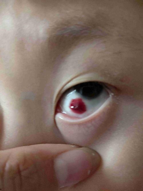 吃瓜吃豆眼早上肿,揭秘早晨眼部肿胀之谜